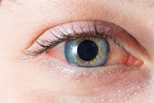 Ojos irritados y enrojecidos – Como tratarlos | Optrex